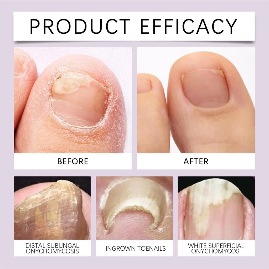 Fungi Free Nails – Natural Anti-Fungal Nail Serum (BUY 1 GET 1 FREE)