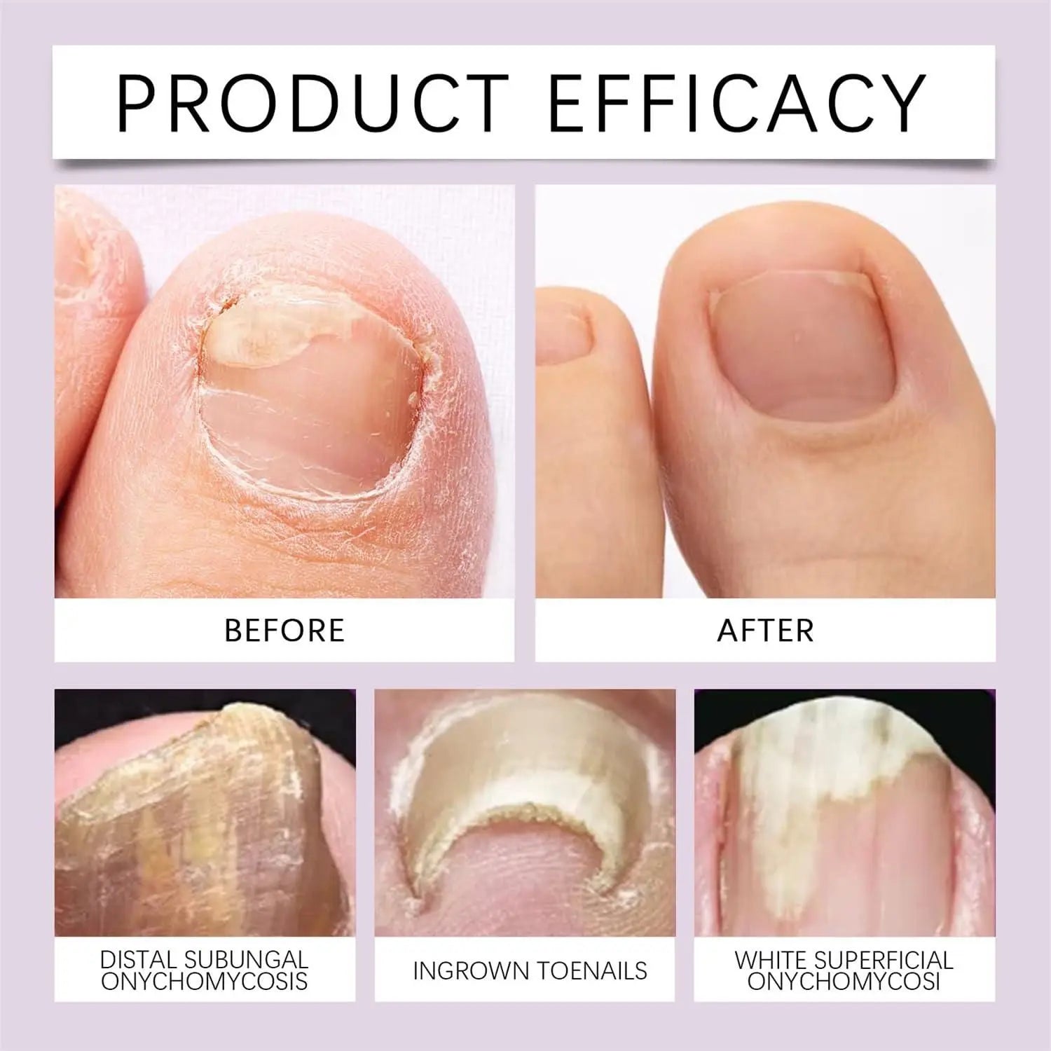 Fungi Free Nails – Natural Anti-Fungal Nail Serum (BUY 1 GET 1 FREE)